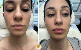 non surgical lip augmentation with