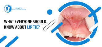 what everyone should know about lip tie