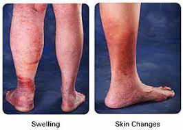 Blood clots are a collection of sticky blood cells that form when a blood vessel is damaged. Dvt Deep Venous Thrombosis Treatment Blood Clot Thrombolysis