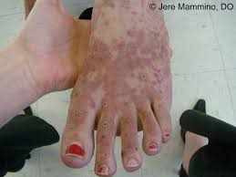 Petechiae are tiny red, flat spots that appear on your skin. Henoch Schonlein Purpura American Osteopathic College Of Dermatology Aocd
