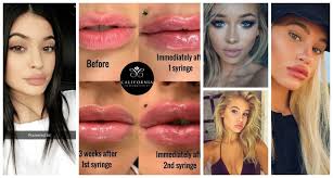 lip fillers why is everyone getting