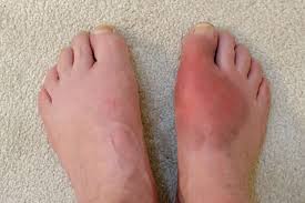 gout inflammatory arthritis how it