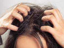 scalp build up definition causes and