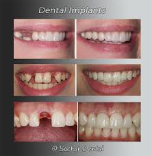 If you get dental implants, you can expect to spend $3,000 to $5,000 per tooth. Dentist Nyc Dental Implants Manhattan Sachar Dental Nyc