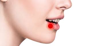 how to treat canker sores at home and