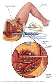 Bowel problems diarrhea and constipation are bowel symptoms which could be early warning signs of prostate cancer. Prostate Cancer Diagnosis And Treatment Mayo Clinic