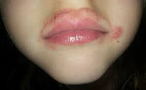 what causes rash around lips to kids
