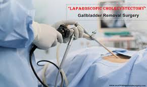 gallbladder removal surgery cost