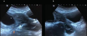 The results in 4350 patients confirmed that ultrasound examination, both transabdominal and transvaginal. The Past Present And Future Of Diagnostic Imaging In Ovarian Cancer Intechopen