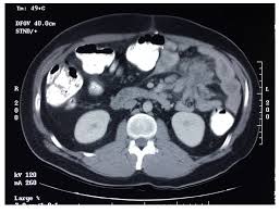 Maybe you would like to learn more about one of these? Unusual Radiologic Presentations Of Malignant Peritoneal Mesothelioma