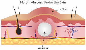 what is a abscess ask our