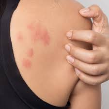 stress hives causes treatment and more