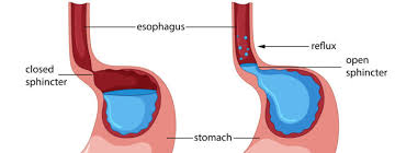 Gastroesophageal Reflux Symptoms Of