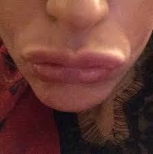 dent in lip after filler is this
