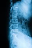 Image result for icd-10 code for c7 wedge compression fracture