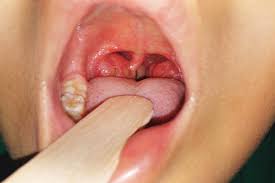 sore throat signs causes and treatment