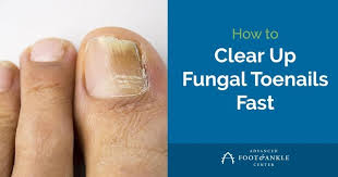 how to clear up fungal toenails fast