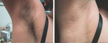 Laser hair removal in london you might think that laser hair removal london prices are too much. Laser Hair Removal London London Premier Laser Clinic