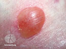 friction blister causes treatment and