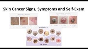 skin cancer signs symptoms and self