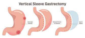 gastric sleeve cost more explained by