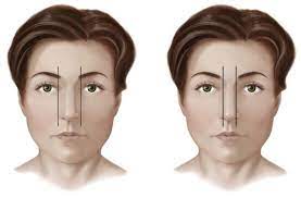 Nose job for wide nose bridge. A Complete Guide To Wide Nose Rhinoplasty Nose Jobs For Wide Noses