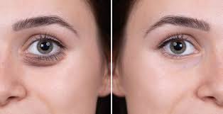 Unless your bags or circles contain a lot of fluid or consist of a lot of slack skin, hyaluronic acid fillers may be useful. Tear Trough Filler Hunar Clinic
