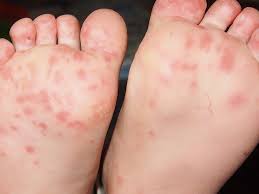 foot rash causes symptoms and treatments