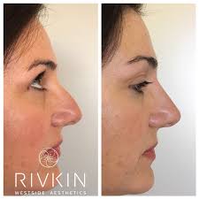 Nose fillers might be a better option for these patients. Non Surgical Nose Job Nose Job Nose Fillers Nonsurgical Nose Job