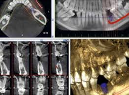 cone beam 3d dental scan in glen