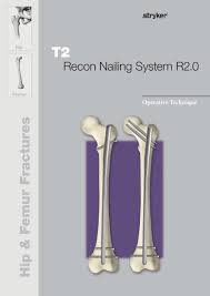 t2 recon nailing system r2 0 operative