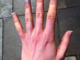 my hands turn blue when they re cold