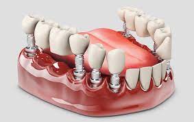 what are fixed partial dentures los