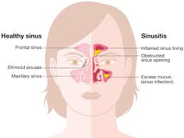 sinus infection thomasville acute
