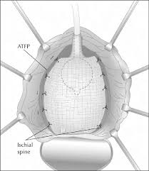 anterior repair with mesh graft the