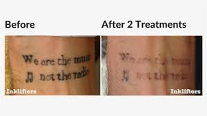 second treatment laser tattoo removal