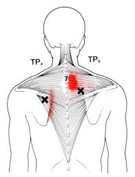 Trapezius The Trigger Point Referred Pain Guide