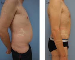 laser assisted liposuction in