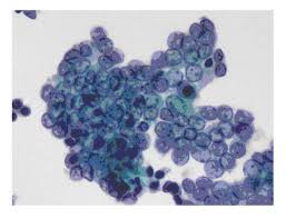 To determine the value of fnac in the diagnosis of thyroid nodules, thyroid cytology of 100 patients were observed from 01/07/2014 to. Cytopathologic Diagnosis Of Fine Needle Aspiration Biopsies Of Thyroid Nodules