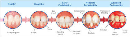 Periodontal Disease Paradise Dental Professionals West