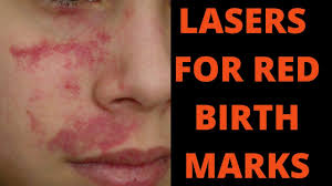 birthmarks removal you