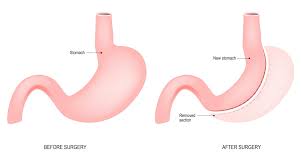 gastric sleeve surgery what you need
