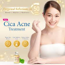 acne treatment singapore cica