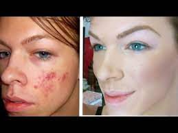 full coverage acne foundation using