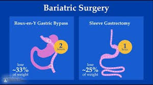 weight loss surgery options brigham