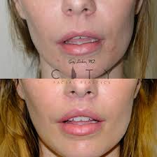 lip enhancement nyc lip augmentation