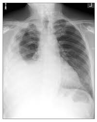 Physicians have a number of imaging tests at their disposal to investigate the various symptoms and physical conditions caused by the disease. Malignant Mesothelioma A Case Presentation And Review