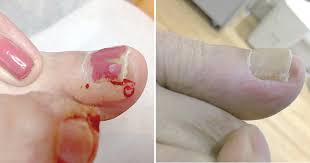wart treatments swift therapy the