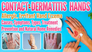 contact dermais hands types causes