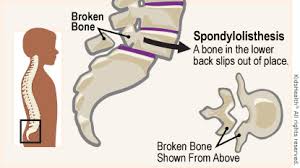 The backbone is, therefore, directly related to biological molecules' function. Spondylolisthesis For Parents Nemours Kidshealth